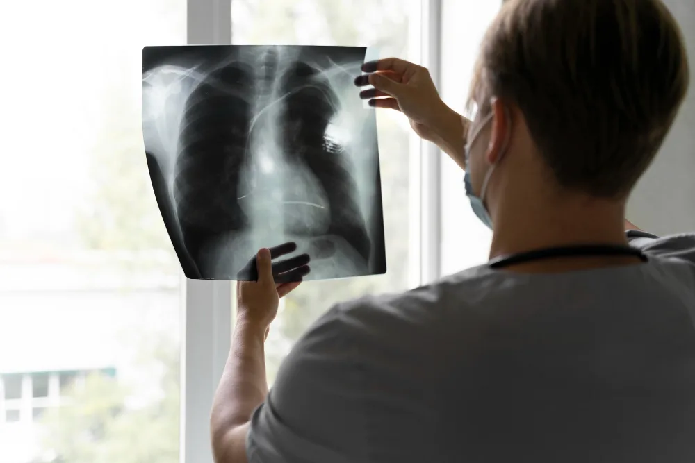 Derrame pleural