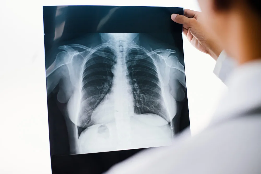 Fractura de costillas en Pachuca
